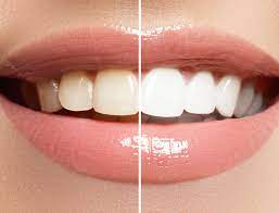 HiSmile V34™